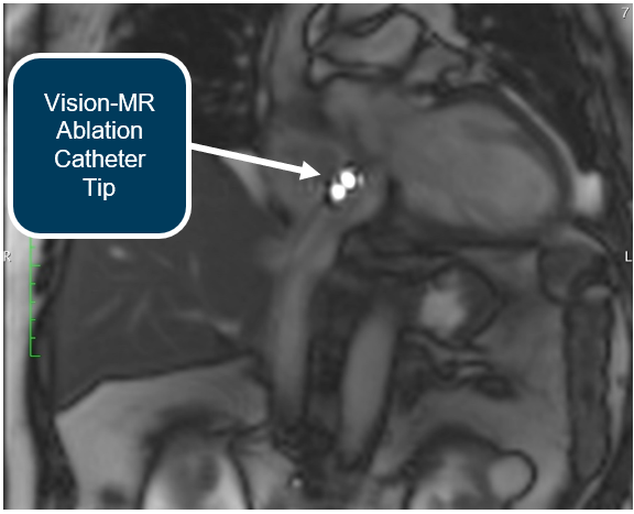 Active Catheter Imaging of the Vision-MR Ablation Catheter