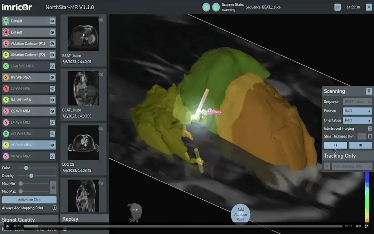 Place and track Ablation Points and Measurement Points